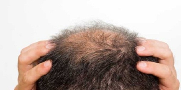What Are Your Hair Loss Causes & How Acupuncture Help In This